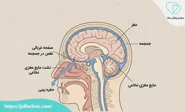 نشت مایع مغزی نخاعی از بینی