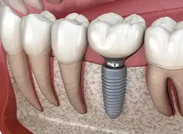 ایمپلنت دندان