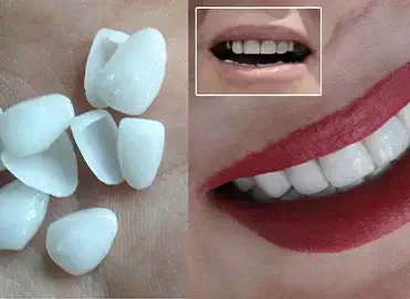 لمینت دندان