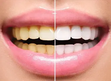 بلیچینگ دندان