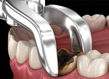 عصب کشی دندان