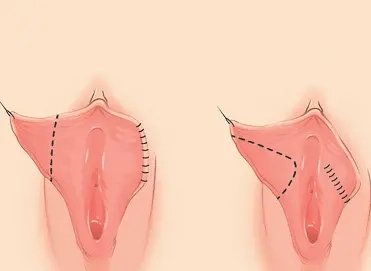 عمل زیبایی واژن(لابیاپلاستی)