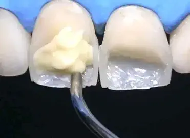 کامپوزیت دندان