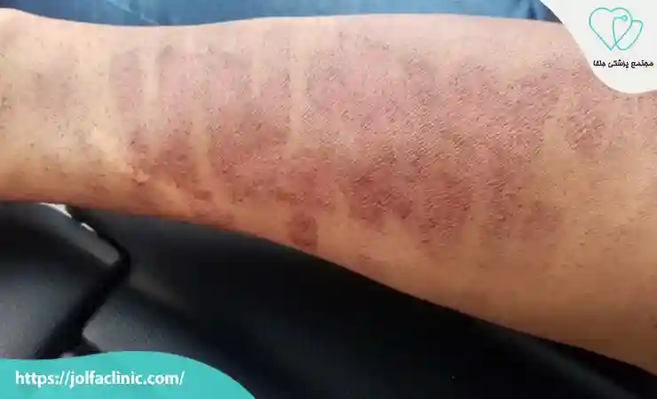 سوختگی بعد از لیزر موهای زائد