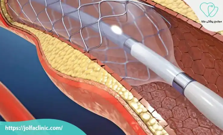 آنژیوپلاستی و استنت گذاری