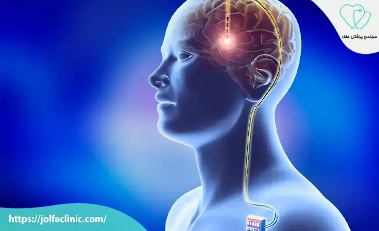 تحریک الکتریکی مغز برای درمان افسردگی