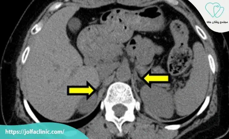 تصویربرداری غده فوق کلیوی