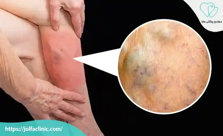 ایجاد لخته های خونی (ترومبوفلبیت)