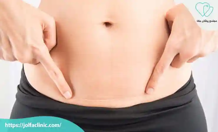 زخم اسکار سزارین یا نیچ سزارین چیست؟