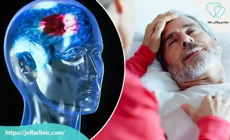 علت سکته مغزی و انواع آن