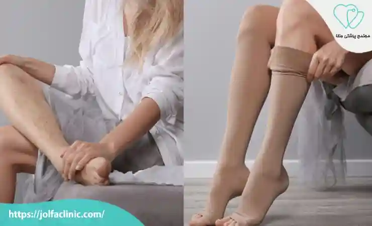 استفاده از جوراب های واریس