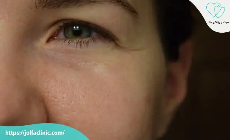 علت‌ های اصلی گلوله شدن فیلر زیر چشم