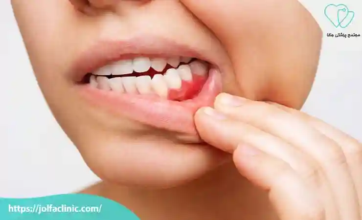 افزایش حساسیت لثه ها در دوران بارداری