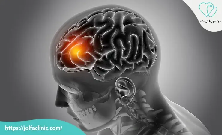بدترین نوع تومور مغزی