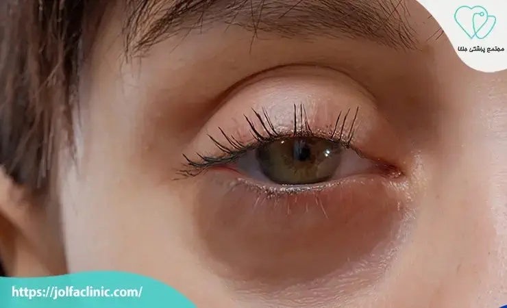 مشکلات لنفاوی یا احتباس مایع در زیر چشم