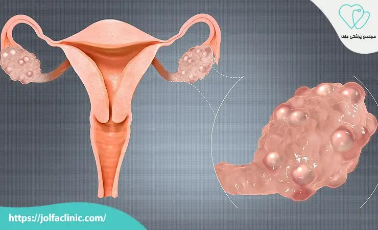 سندرم های متابولیک و سندرم تخمدان پلی کیستیک