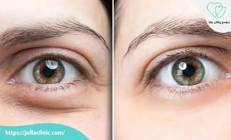 روش های رفع گلوله شدن فیلر زیر چشم