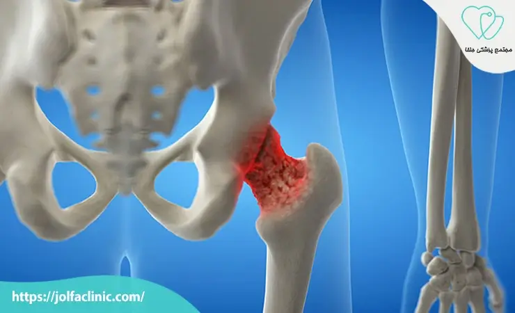 پوکی استخوان و اختلالات کلسیم