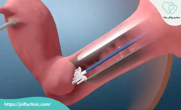 هدف از انجام تست پاپ اسمیر