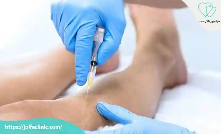 اسکلروتراپی واریس