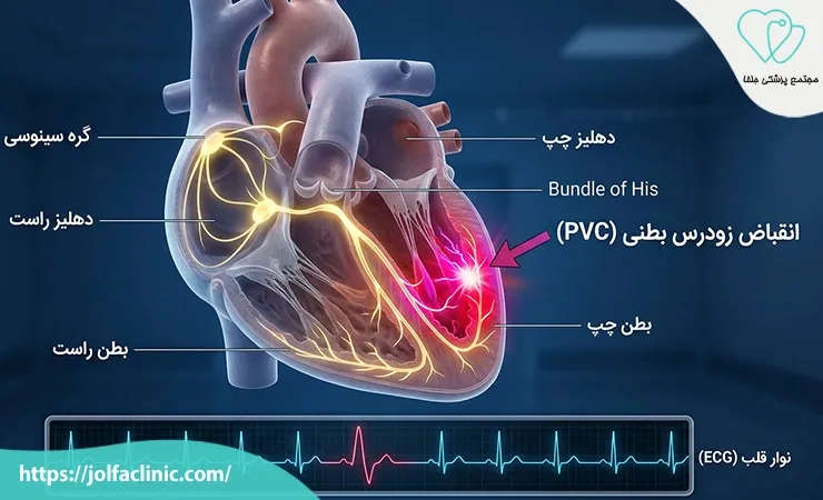 پی وی سی قلب (PVC) چیست؟