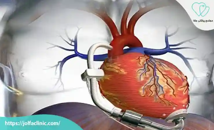 کارهای لازم برای نارسایی قلبی