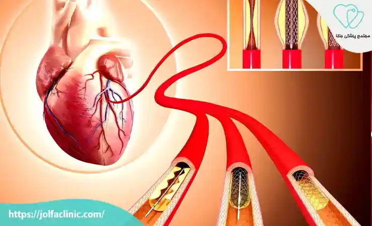 چه زمانی به آنژیوپلاستی نیاز داریم
