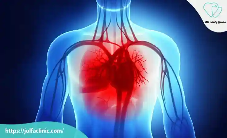 اختلال در عملکرد قلب یا کاهش شدید جریان خون به عضله قلب