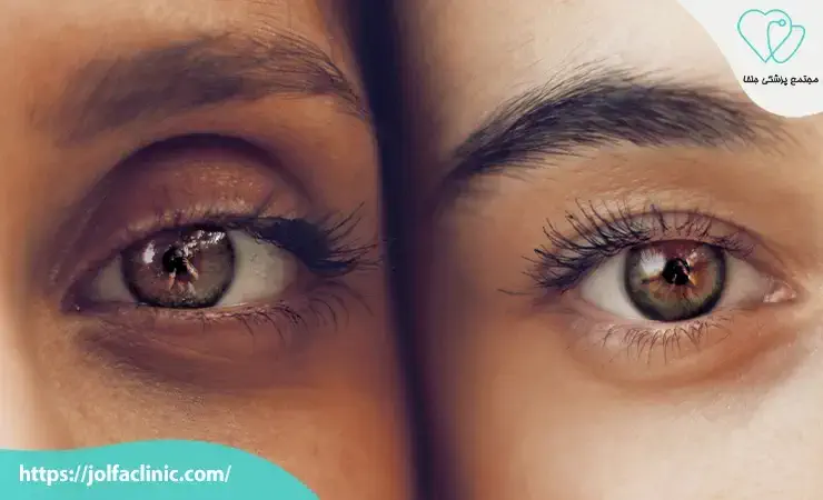 علت های اصلی گلوله شدن فیلر زیر چشم کدام اند؟