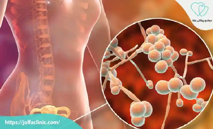 تشخیص عفونت  های ویروسی و قارچی مرتبط با ناحیه دهانه رحم