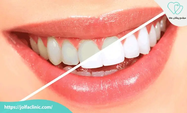فواید و مضرات کامپوزیت دندان