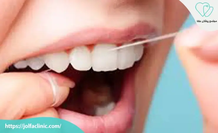 مراقبت های بعد از کامپوزیت دندان