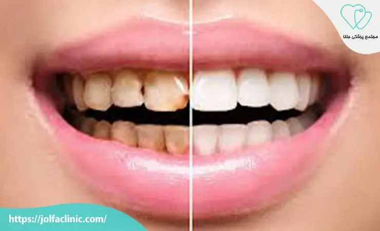 مزایای کامپوزیت دندان