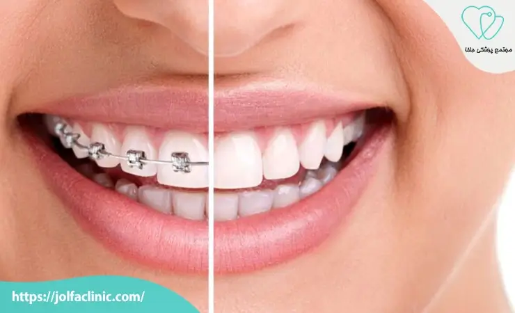 مزایای ارتودنسی دندان
