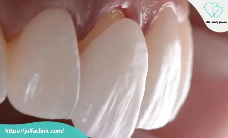 لمینت سرامیکی