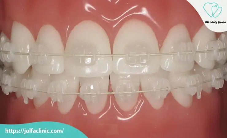 ارتودنسی سرامیکی