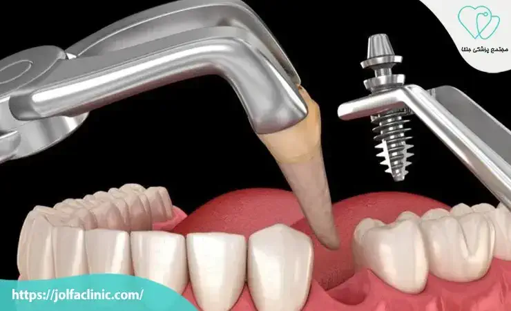 ایمپلنت معمولی
