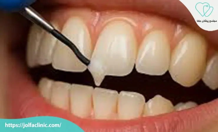 هزینه کامپوزیت دندان