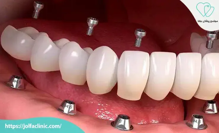 هزینه ایمپلنت دندان در ۱۴۰۴