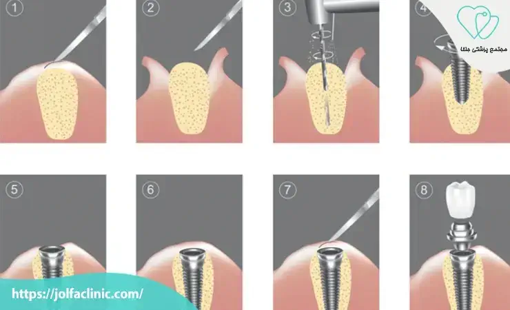 مراحل انجام ایمپلنت دندان