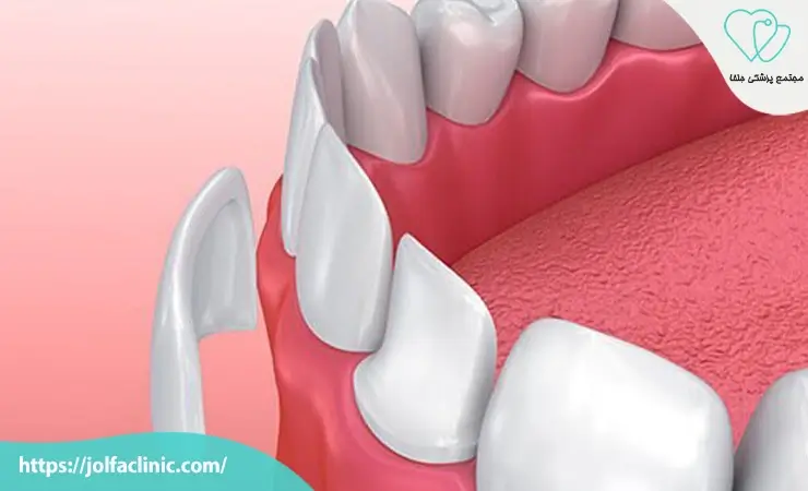 قیمت لمینت دندان