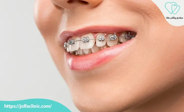 هزینه ارتودنسی دندان