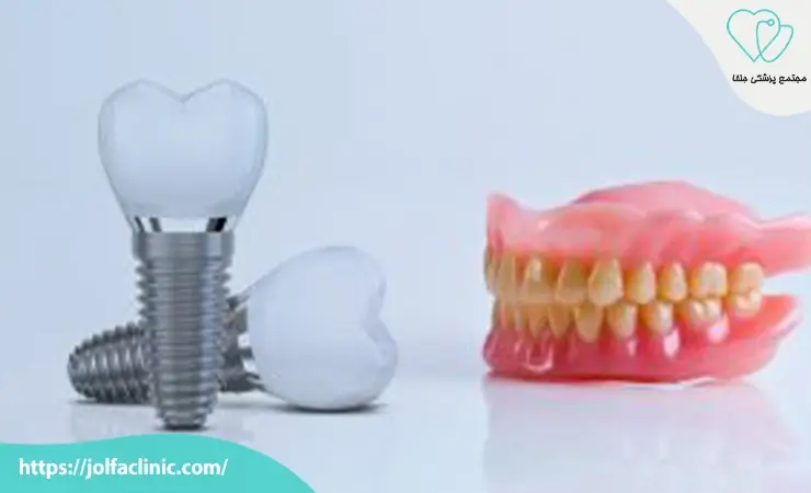 پروتز دندان یا ایمپلنت؟ کدام بهتر است؟