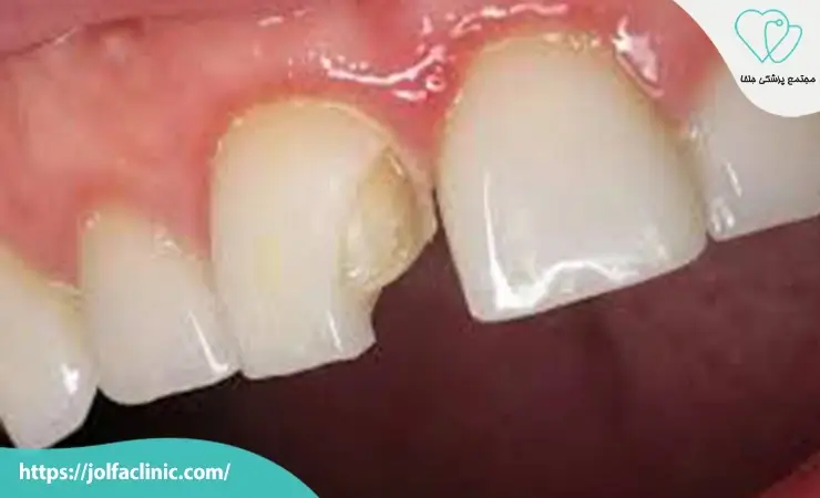 معایب لمینت دندان
