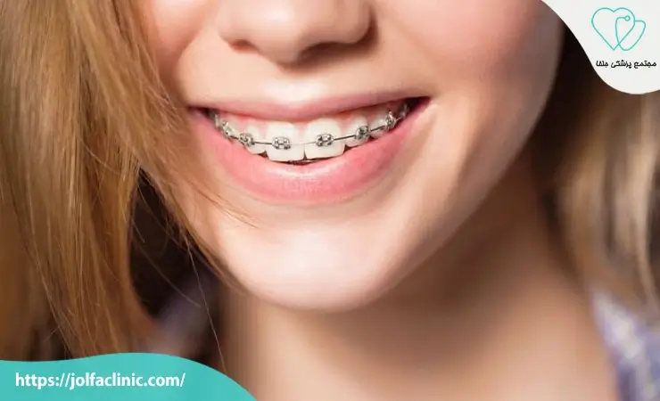 مدت زمان درمان ارتودنسی