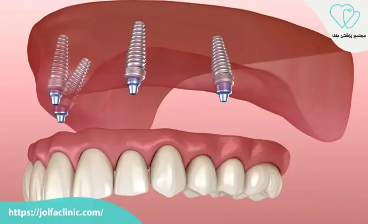 پروتز دندان ثابت