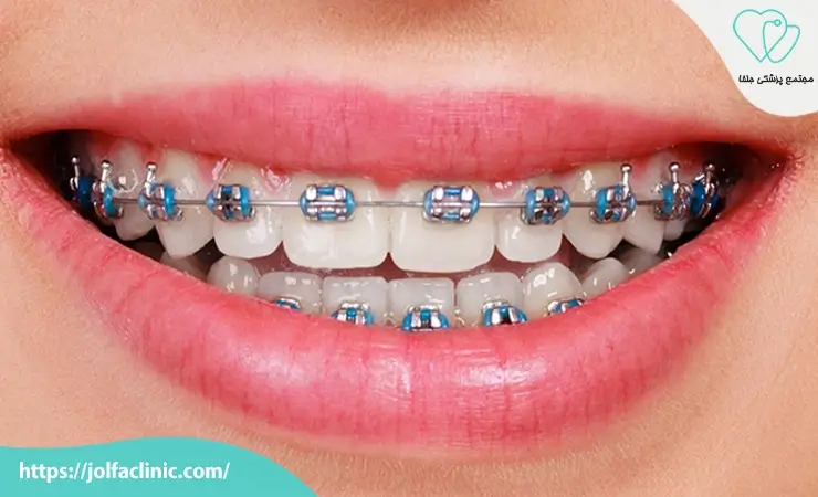 ارتودنسی ثابت فلزی