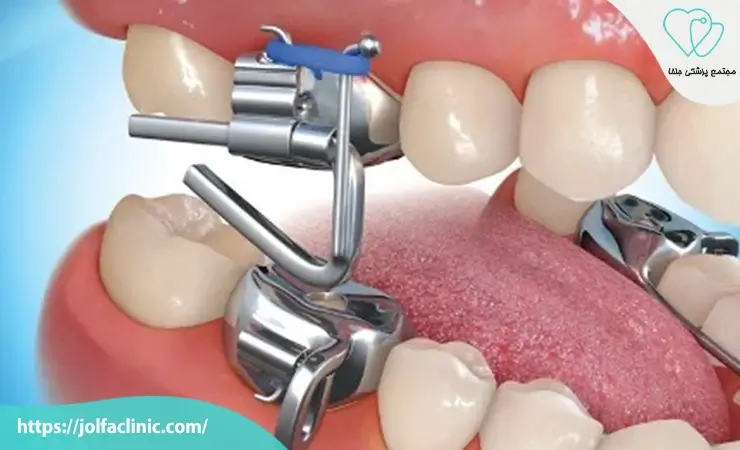 ارتودنسی فانکشنال