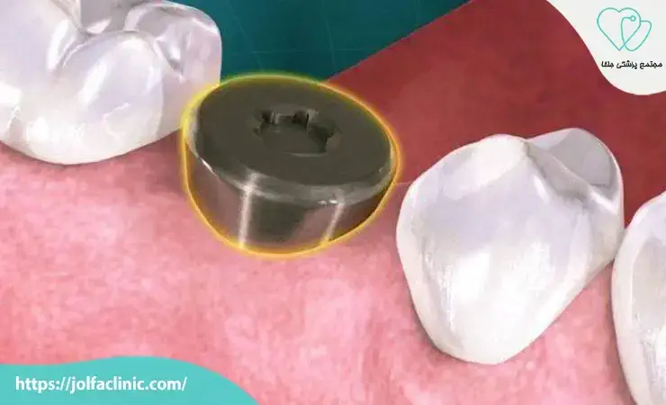 پیچ پوششی یا Healing Cap