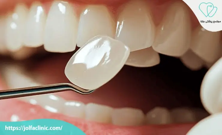 طرز گذاشتن لمینت دندان